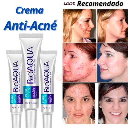 Crema Anti Acné "Bioaqua"